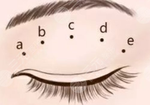 怎么做雙眼皮自然？