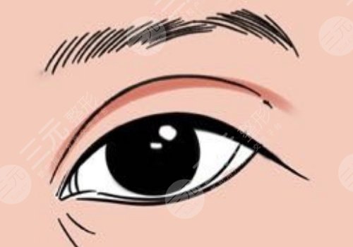怎么做雙眼皮自然？