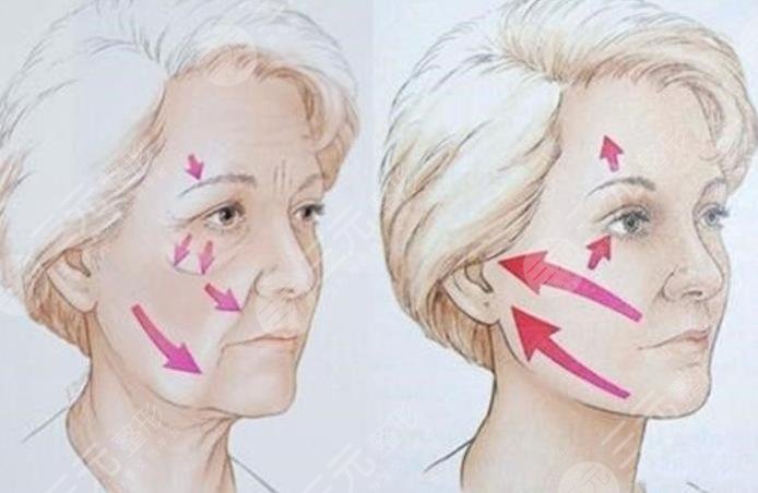 王翼耕拉皮手術(shù)案例