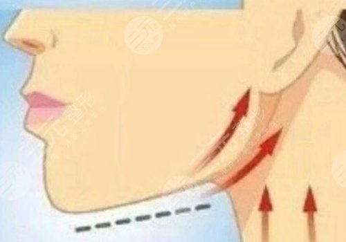 面部外輪廓固定怎么做？