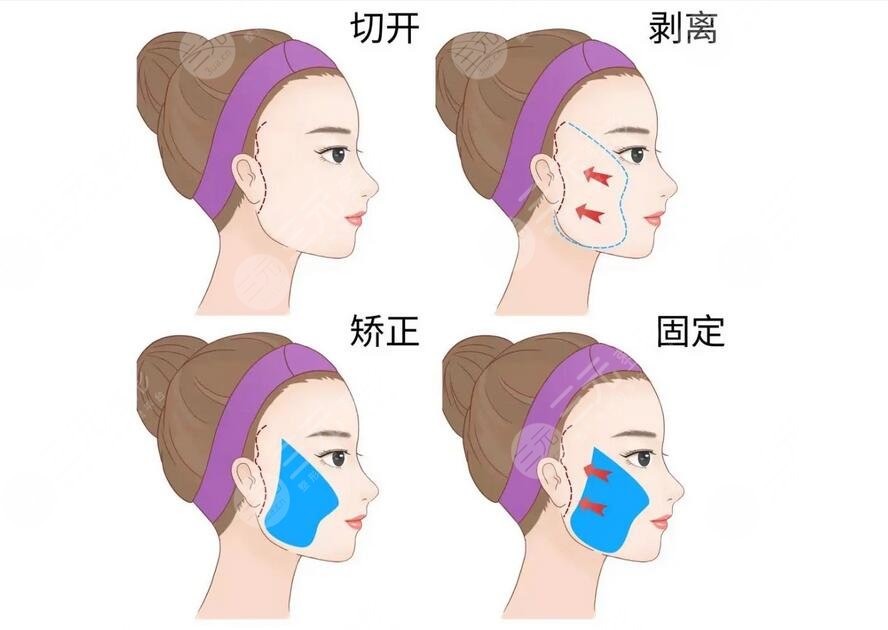 50歲面部下垂怎樣能恢復(fù)