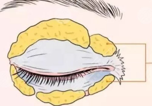 腫眼泡抽脂多少錢？