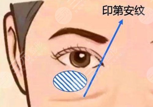 印第安紋和淚溝的區(qū)別是什么？