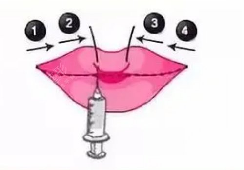 唇部填充用脂肪還是玻尿酸？