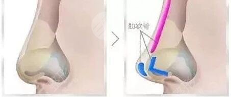 自體脂肪隆鼻