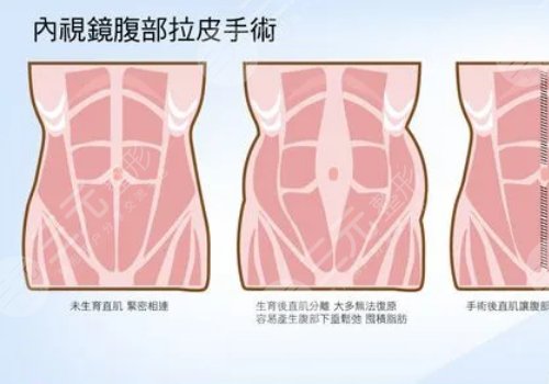 腹部拉皮和腹壁整形一樣嗎？