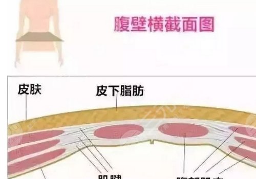 腹部拉皮和腹壁整形一樣嗎？