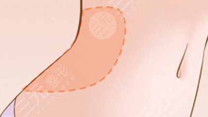 腰腹環(huán)吸包括哪幾個(gè)部位?