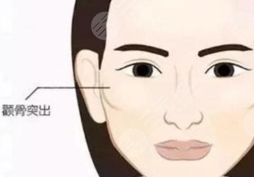 顴骨高怎么改良臉型？