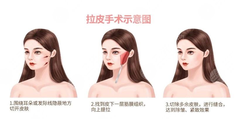 魏廣運醫(yī)生拉皮手術(shù)案例