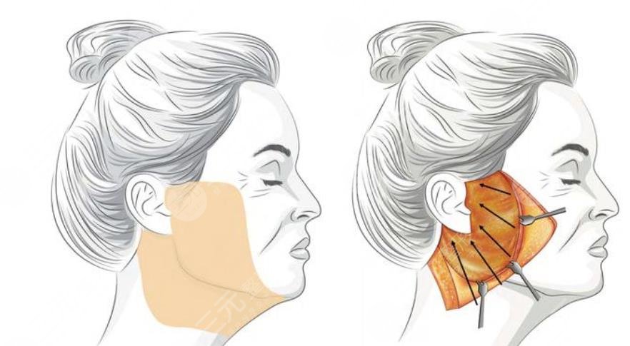 倪鋒醫(yī)生做拉皮怎么樣