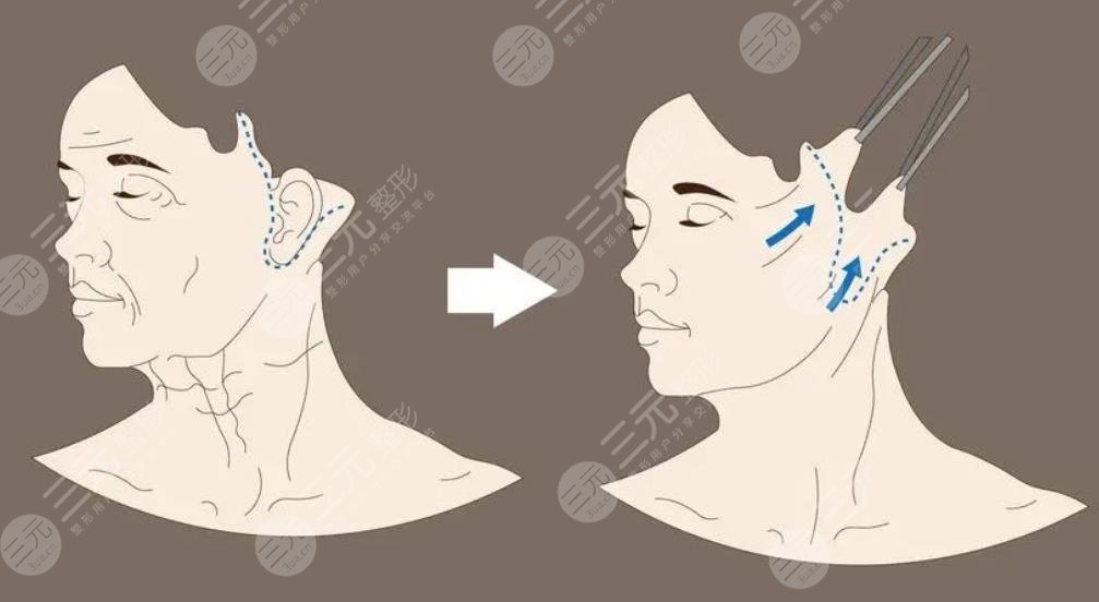 雙矢量組織復(fù)位術(shù)