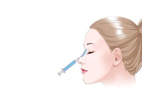 濡白天使隆鼻維持多久？