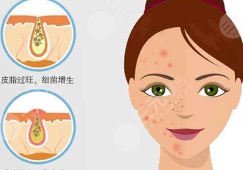 t區(qū)反復(fù)長(zhǎng)痘痘的原因是什么？