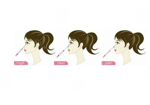 寶尼達隆鼻可以維持多久？