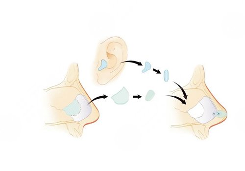 媽生鼻多少錢(qián)