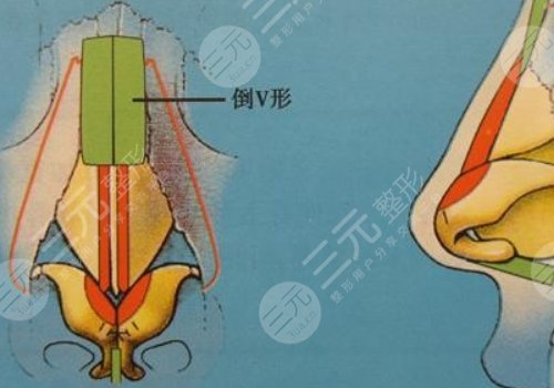 媽生鼻多少錢(qián)