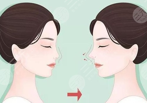 媽生鼻多少錢(qián)