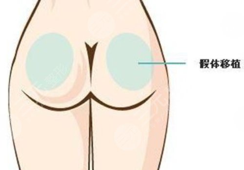 假體豐臀需要多少錢？