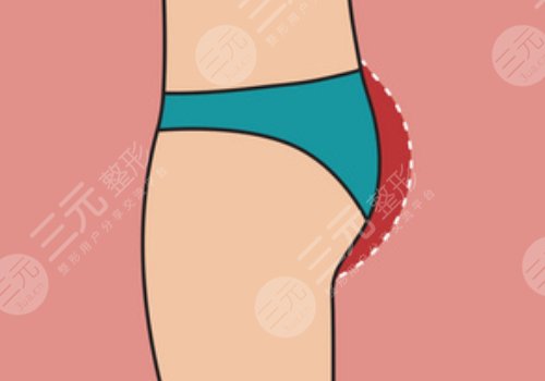 假體豐臀需要多少錢？