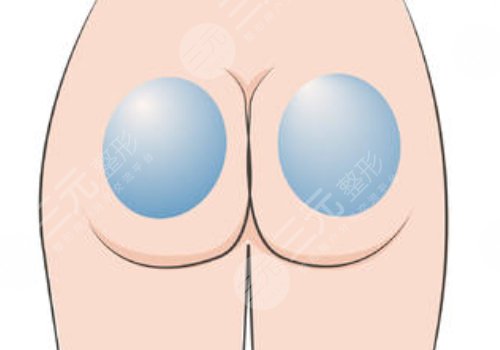 假體豐臀需要多少錢？