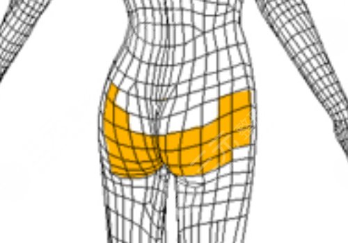 假體豐臀需要多少錢？