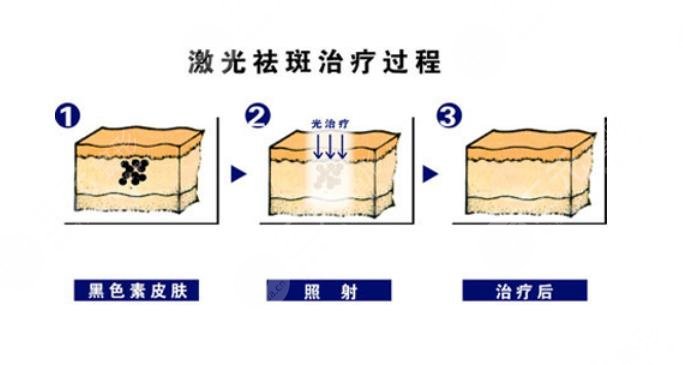 中山三院整形科激光祛斑案例分享
