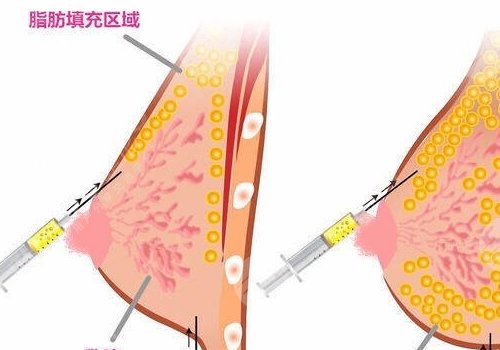胸型不好看可以調(diào)整嗎？