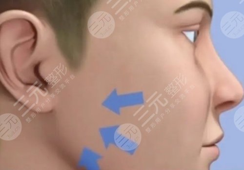 外輪廓固定提升有哪些手術方案？