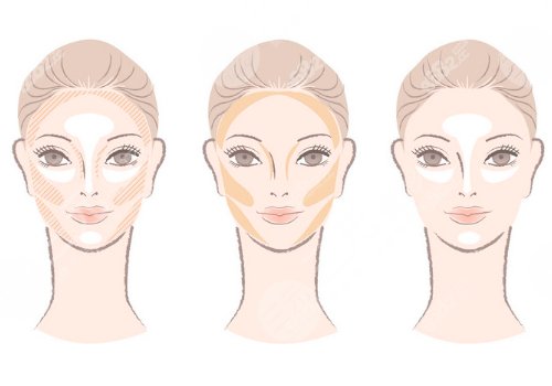 外輪廓固定提升有哪些手術方案？