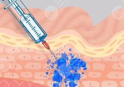外輪廓固定提升有哪些手術方案？
