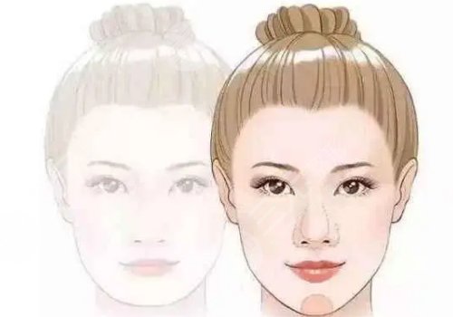 外輪廓提升需要幾支玻尿酸？