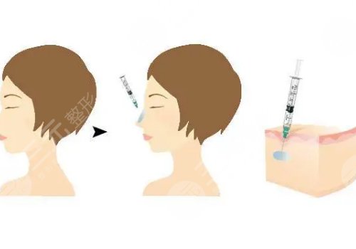 外輪廓提升需要幾支玻尿酸？