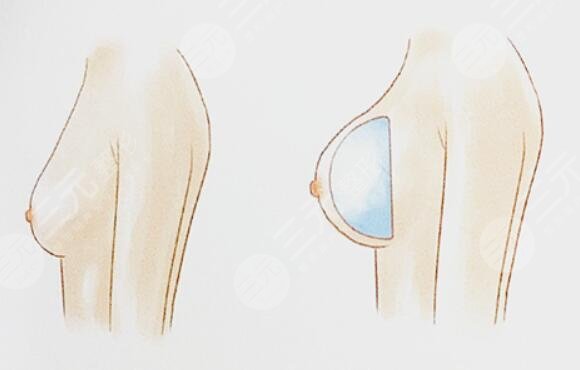 乳房整形效果怎么樣