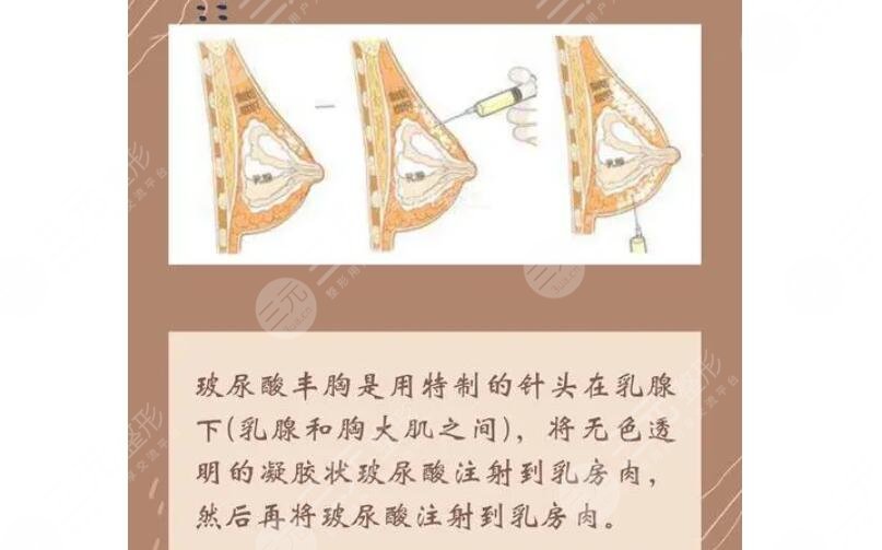 玻尿酸豐胸優(yōu)缺點