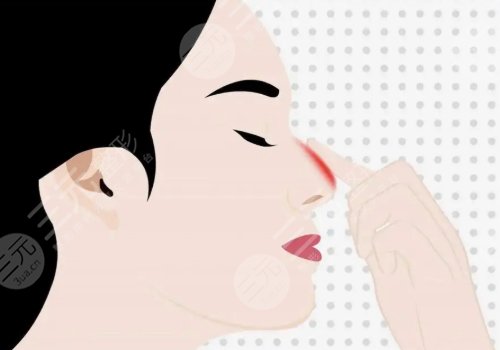 鼻子修復(fù)必須要滿3個(gè)月嗎？