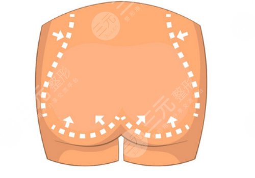 媽媽臀吸脂多久可以恢復(fù)？