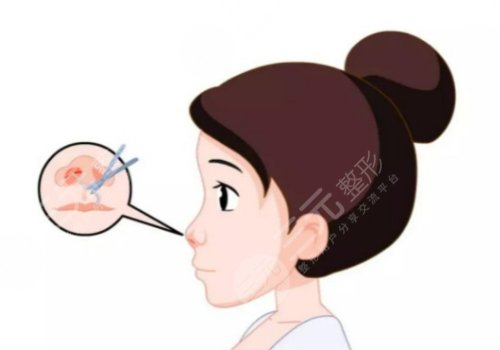 翹鼻和直鼻哪個(gè)好看