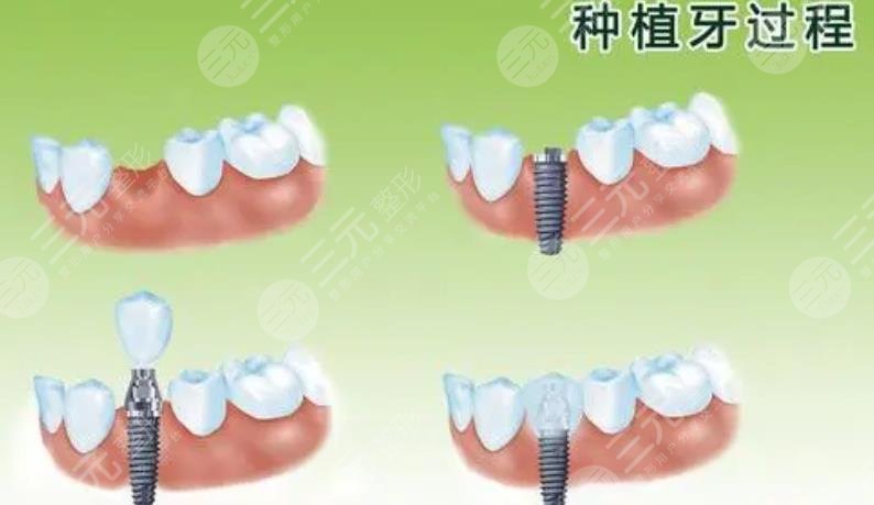 上海第十人民醫(yī)院種牙齒案例