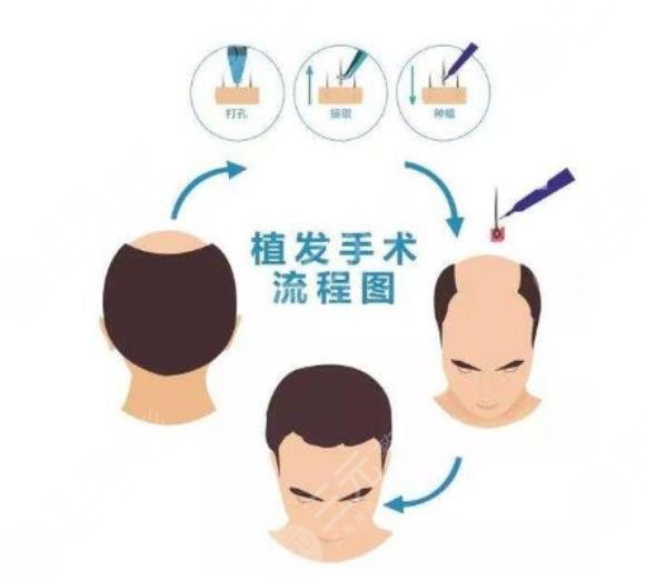 天津總醫(yī)院植發(fā)案例