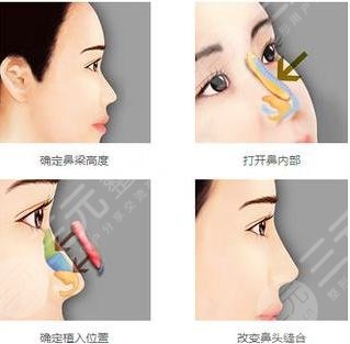 顏玲做鼻子案例