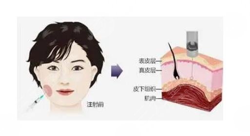 方圓臉怎么變成瓜子臉？