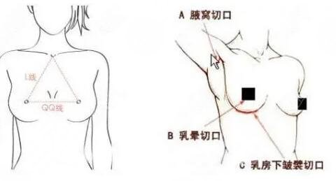 假體隆胸切口在什么位置比較好？常用三個(gè)切口位置，優(yōu)缺點(diǎn)告訴你！