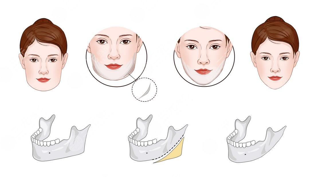 上海時光做顴骨多少錢