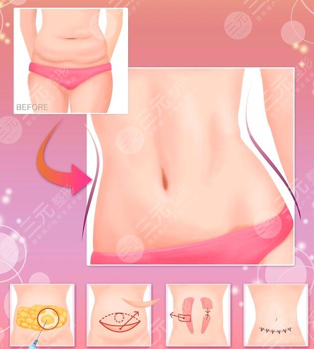 全身抽脂可以保持多久？