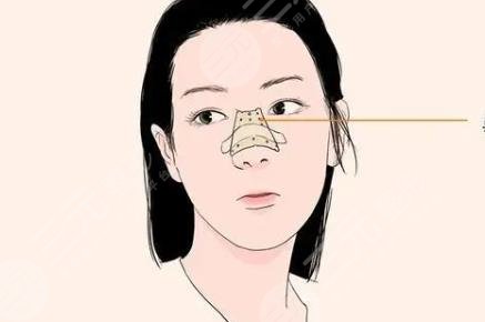 進(jìn)口膨體和國產(chǎn)膨體有什么區(qū)別