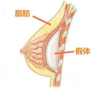 假體隆胸術后可以哺乳嗎?