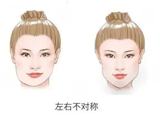 下頜骨一高一低臉歪怎么矯正？左右臉不對稱能矯正過來嗎？