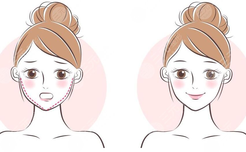 發(fā)腮臉變寬了還能變回去不？