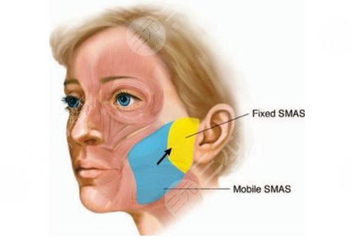 小切口拉皮手術(shù)費多少錢
